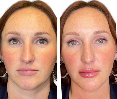 Lip Fillers Before & After Gallery - Patient 219108 - Image 1