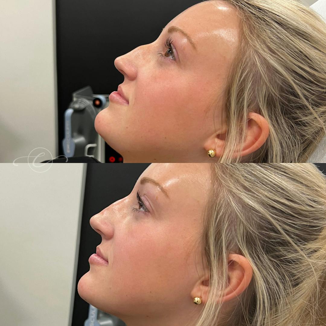 Non-Surgical Rhinoplasty Before & After Gallery - Patient 372156 - Image 1