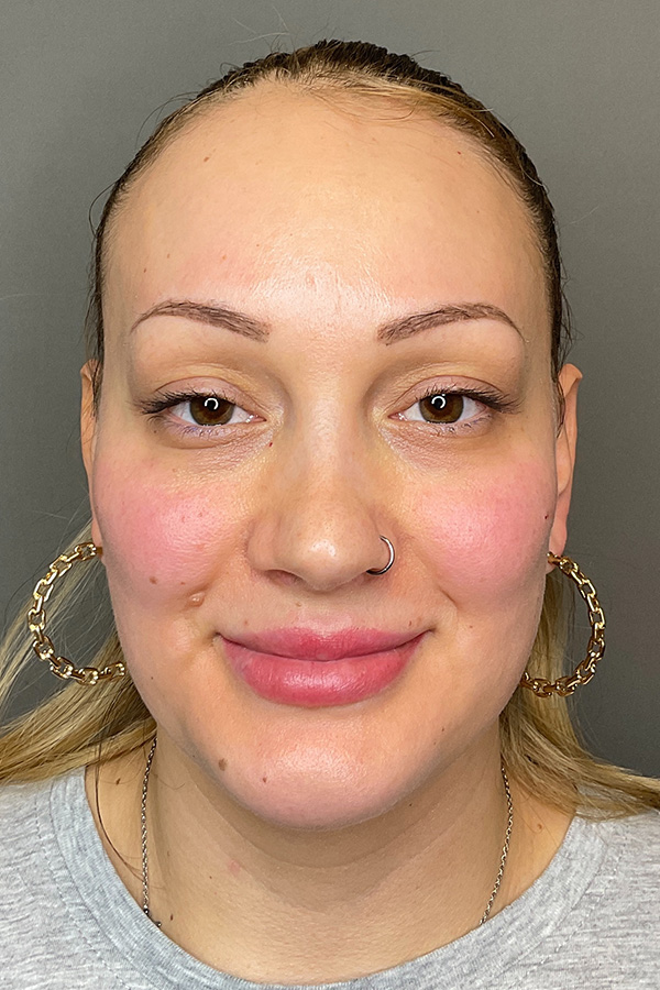 Facial Rejuvenation (Facial Balancing)  Before & After Gallery - Patient 102051 - Image 2