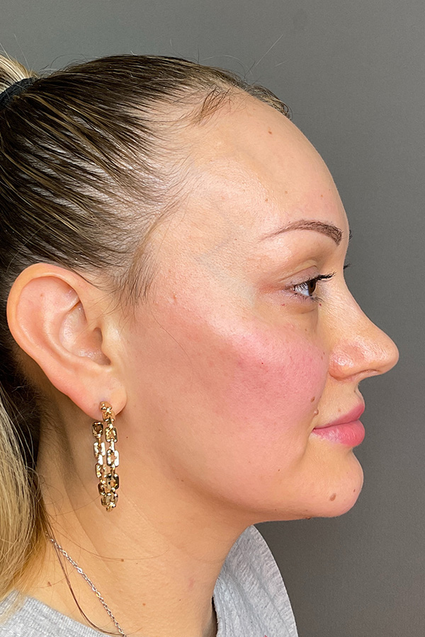 Facial Rejuvenation (Facial Balancing)  Before & After Gallery - Patient 102051 - Image 6