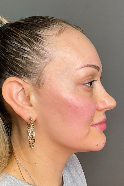 Facial Rejuvenation (Facial Balancing)  Before & After Gallery - Patient 102051 - Image 6