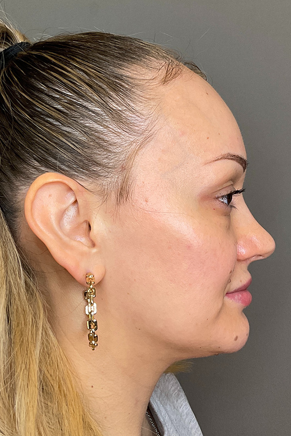 Facial Rejuvenation (Facial Balancing)  Before & After Gallery - Patient 102051 - Image 5