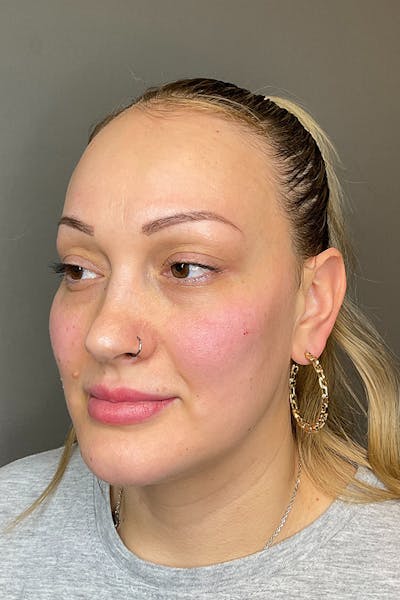 Facial Rejuvenation (Facial Balancing)  Before & After Gallery - Patient 102051 - Image 8