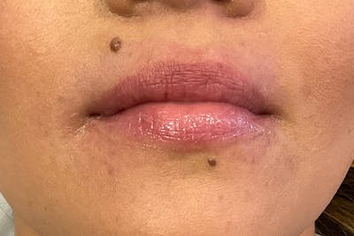 Lip Fillers Before & After Gallery - Patient 173874 - Image 1