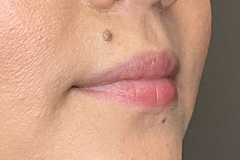 Lip Fillers Before & After Gallery - Patient 173874 - Image 3