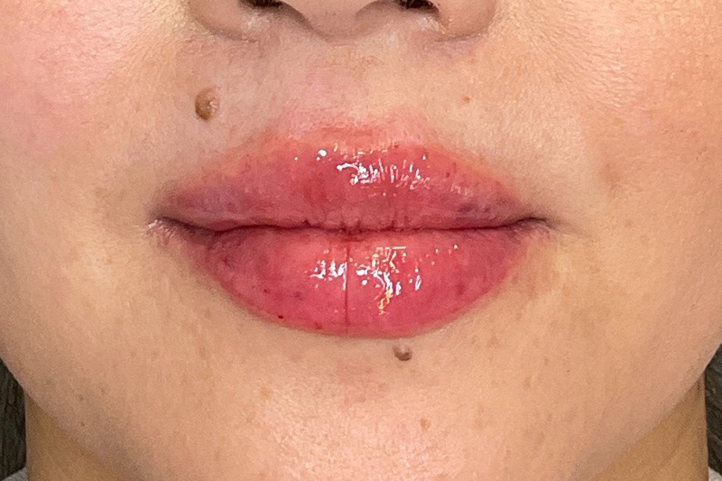 Lip Fillers Before & After Gallery - Patient 173874 - Image 2