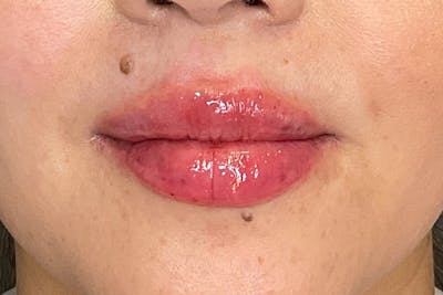 Lip Fillers Before & After Gallery - Patient 173874 - Image 2