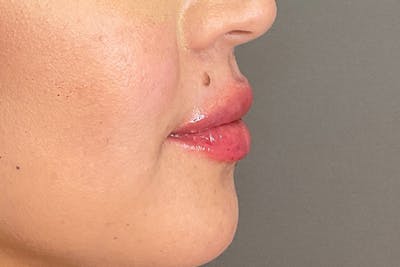 Lip Fillers Before & After Gallery - Patient 173874 - Image 6