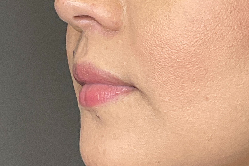 Lip Fillers Before & After Gallery - Patient 173874 - Image 7