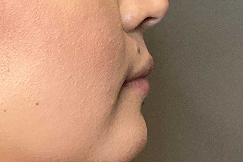 Lip Fillers Before & After Gallery - Patient 173874 - Image 5
