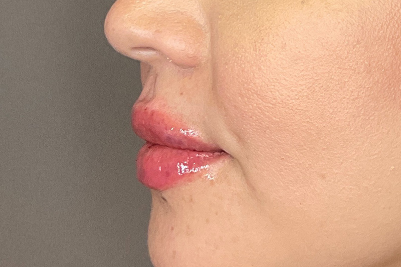 Lip Fillers Before & After Gallery - Patient 173874 - Image 10