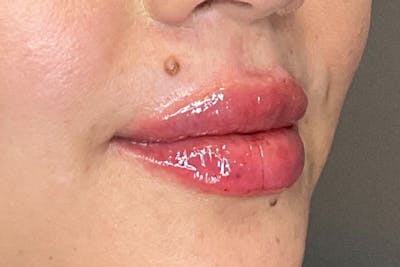 Lip Fillers Before & After Gallery - Patient 173874 - Image 4