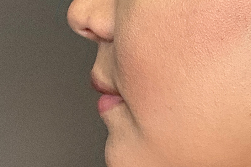 Lip Fillers Before & After Gallery - Patient 173874 - Image 9