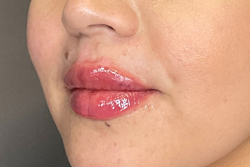 Lip Fillers Before & After Gallery - Patient 173874 - Image 8