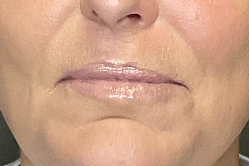 Lip Fillers Before & After Gallery - Patient 214066 - Image 1