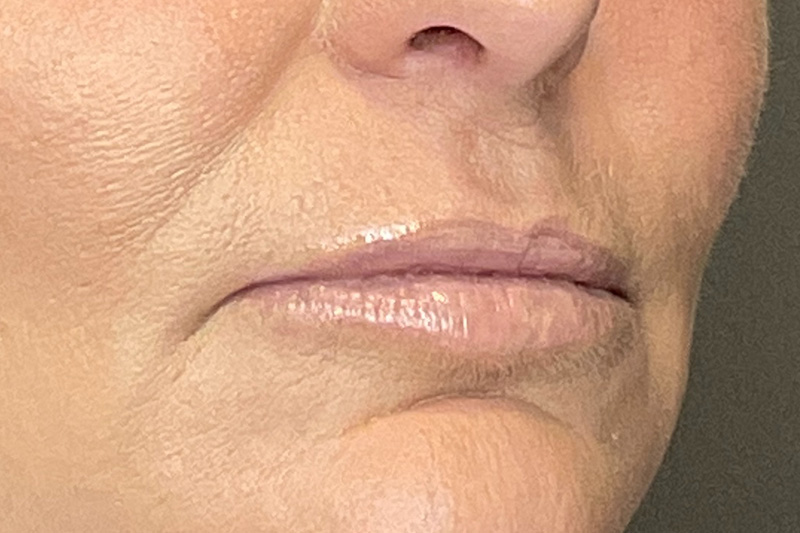 Lip Fillers Before & After Gallery - Patient 214066 - Image 3