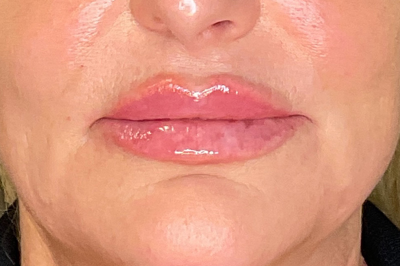 Lip Fillers Before & After Gallery - Patient 214066 - Image 2