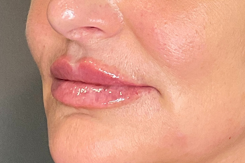 Lip Fillers Before & After Gallery - Patient 214066 - Image 6