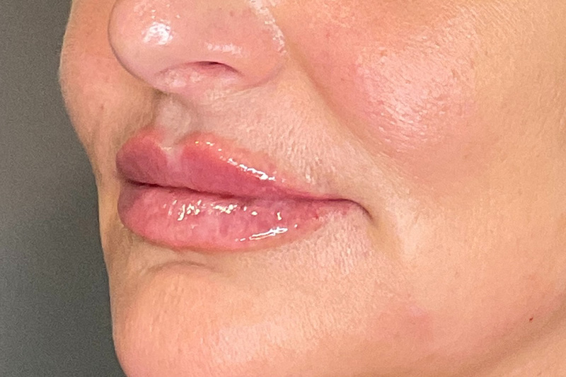 Lip Fillers Before & After Gallery - Patient 214066 - Image 6