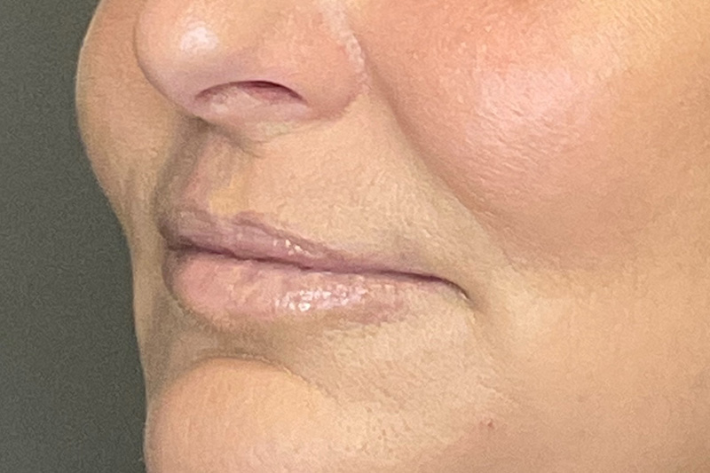 Lip Fillers Before & After Gallery - Patient 214066 - Image 5