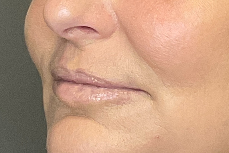 Lip Fillers Before & After Gallery - Patient 214066 - Image 5
