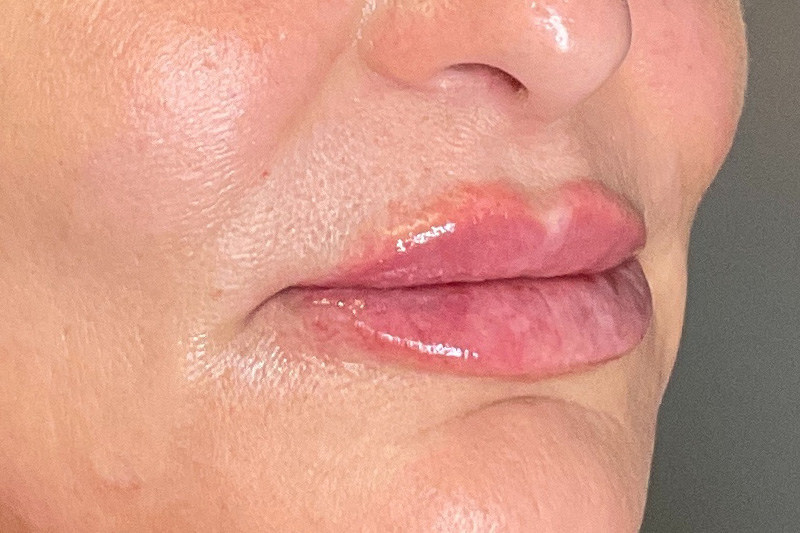 Lip Fillers Before & After Gallery - Patient 214066 - Image 4