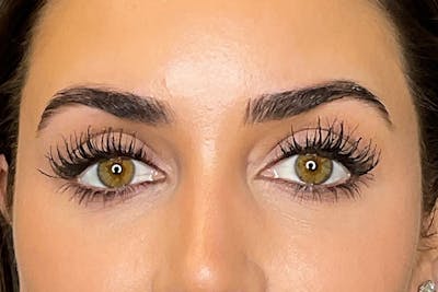 Under-Eye Filler Before & After Gallery - Patient 358239 - Image 2