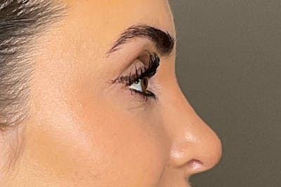 Under-Eye Filler Before & After Gallery - Patient 358239 - Image 6