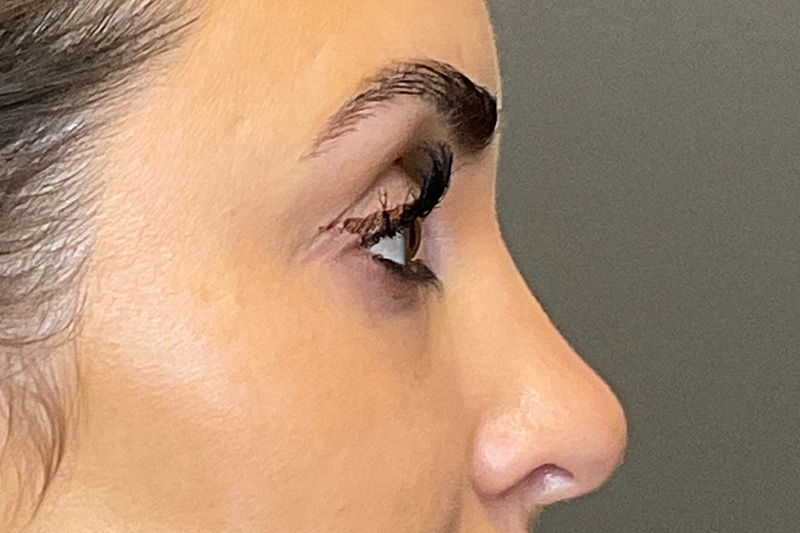 Under-Eye Filler Before & After Gallery - Patient 358239 - Image 5