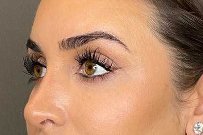 Under-Eye Filler Before & After Gallery - Patient 358239 - Image 8