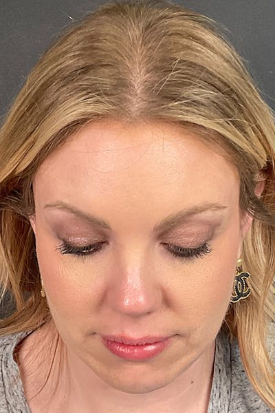 Cheek Filler Before & After Gallery - Patient 261890 - Image 1