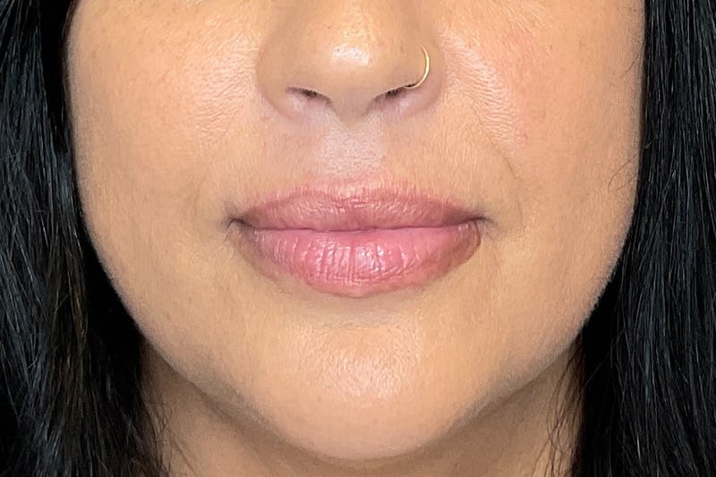 Lip Fillers Before & After Gallery - Patient 200760 - Image 1