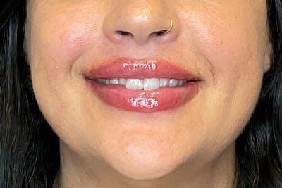 Lip Fillers Before & After Gallery - Patient 200760 - Image 2