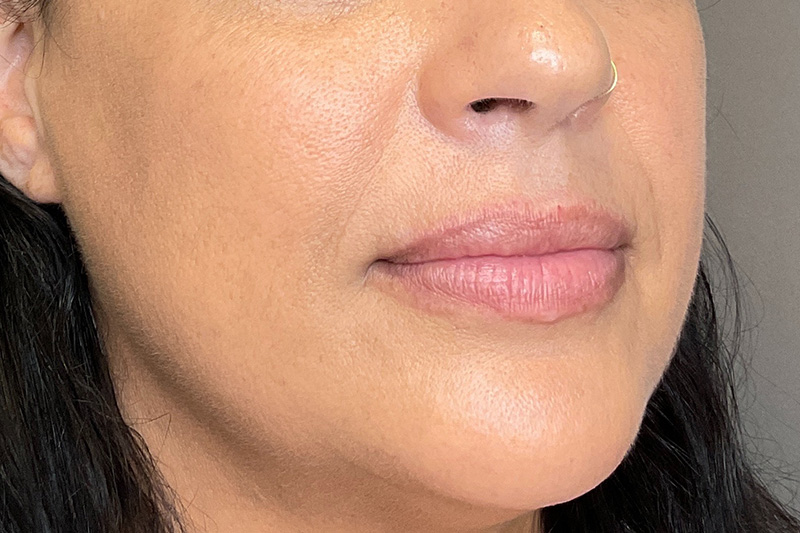 Lip Fillers Before & After Gallery - Patient 200760 - Image 3