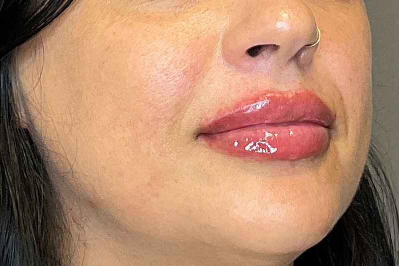 Lip Fillers Before & After Gallery - Patient 200760 - Image 4
