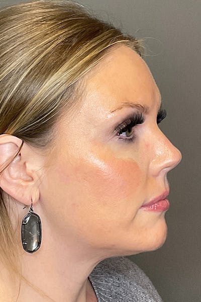 Cheek Filler Before & After Gallery - Patient 261890 - Image 6