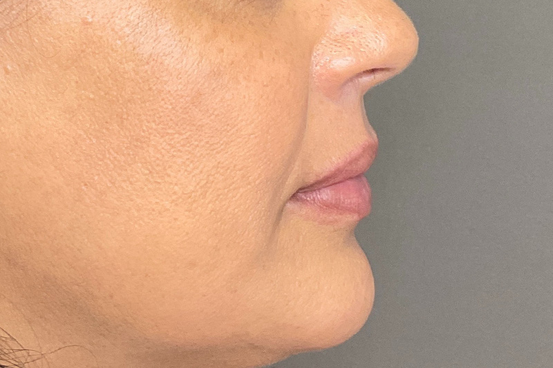 Lip Fillers Before & After Gallery - Patient 200760 - Image 5