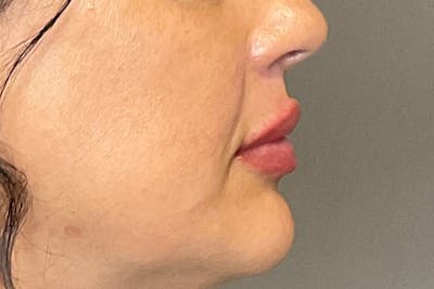 Lip Fillers Before & After Gallery - Patient 200760 - Image 6