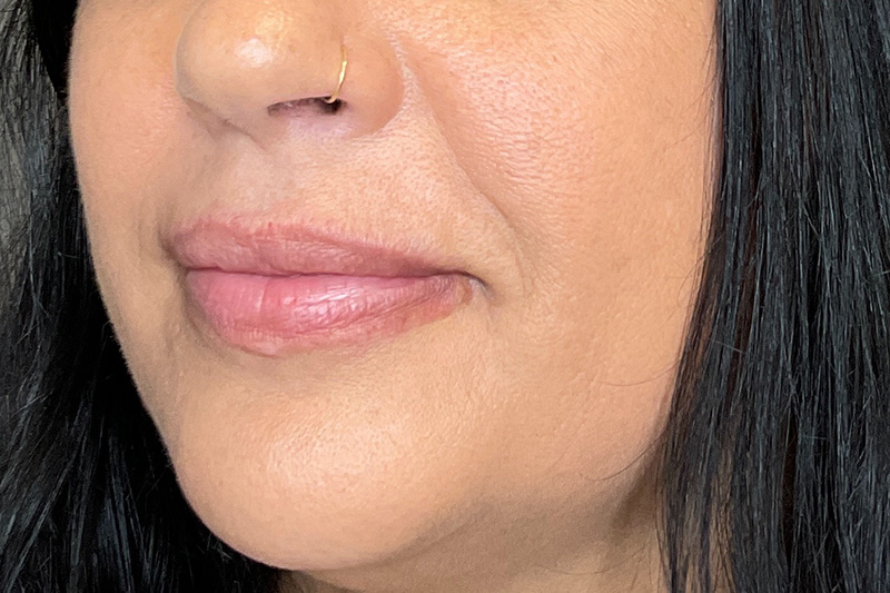 Lip Fillers Before & After Gallery - Patient 200760 - Image 7
