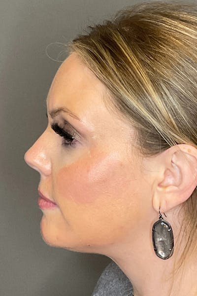 Cheek Filler Before & After Gallery - Patient 261890 - Image 10