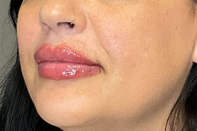 Lip Fillers Before & After Gallery - Patient 200760 - Image 8