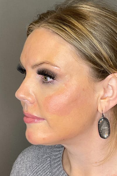 Cheek Filler Before & After Gallery - Patient 261890 - Image 8