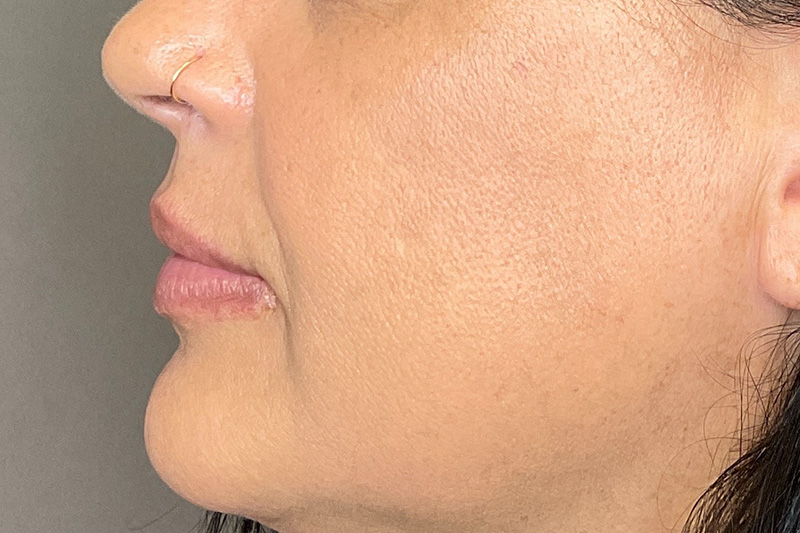 Lip Fillers Before & After Gallery - Patient 200760 - Image 9