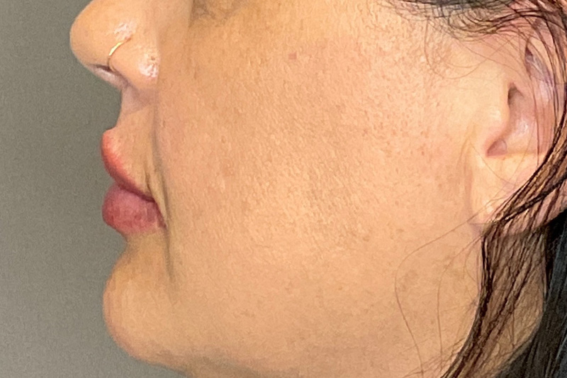Lip Fillers Before & After Gallery - Patient 200760 - Image 10
