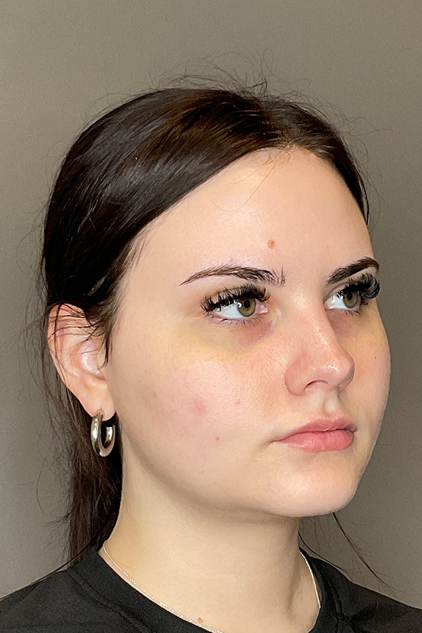 PRF EZ Gel Before & After Gallery - Patient 139491 - Image 3