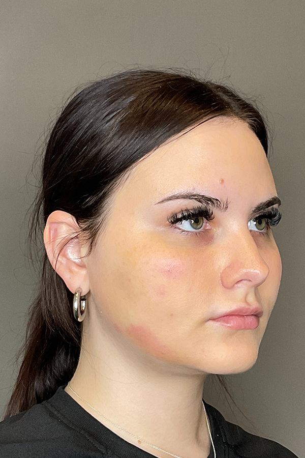 PRF EZ Gel Before & After Gallery - Patient 139491 - Image 4