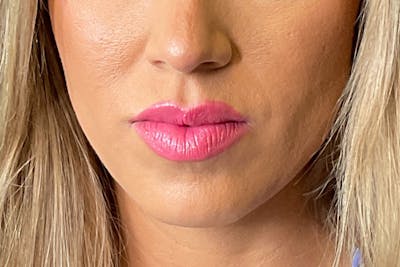 Lip Fillers Before & After Gallery - Patient 314306 - Image 1