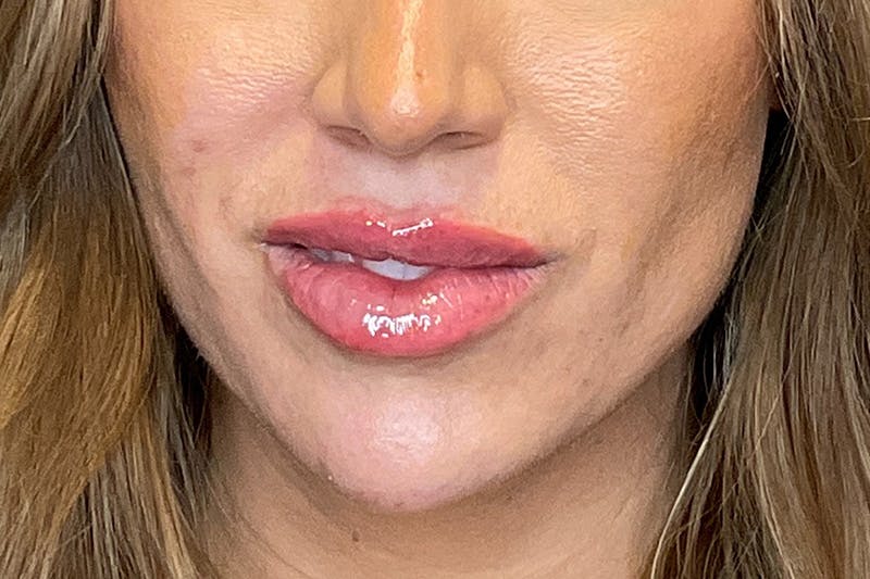 Lip Fillers Before & After Gallery - Patient 314306 - Image 2
