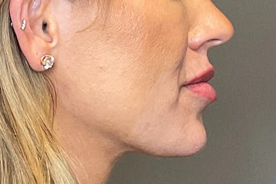 Lip Fillers Before & After Gallery - Patient 314306 - Image 6