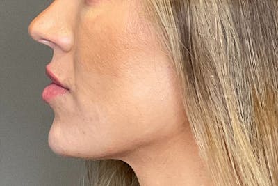 Lip Fillers Before & After Gallery - Patient 314306 - Image 10